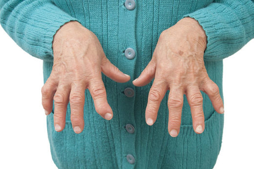 Rheumatic Arthritis Plagues