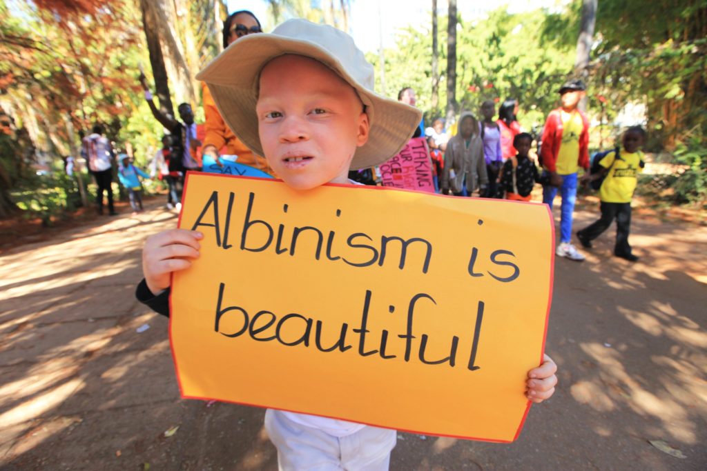 Albinism is beautiful